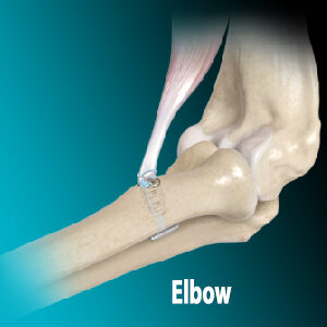 Elbow - Alon Medical Technology Education