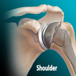 Shoulder - Alon Medical Technology became an Arthrex agency in 2018 and serves both Louisiana and Mississippi.